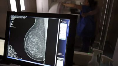 Câncer de mama: uma em cada três pacientes tem menos de 50 anos