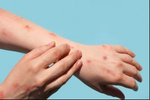 Mundo ultraa 100 mil casos de Mpox desde 2022, diz OMS